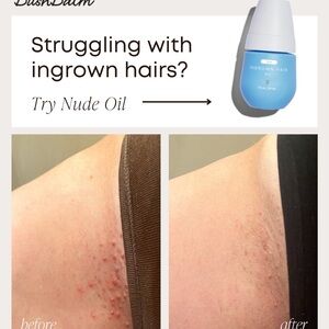 Ingrown Hair Oil - Blue